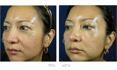 Δυσχρωμίες δέρματος - πριν και μετά την θεραπεία